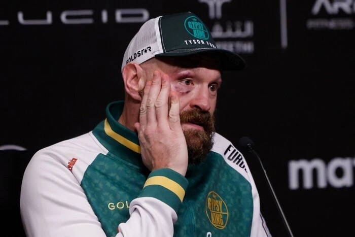 Jak wygląda twarz Fury'ego po ciosach Usyka: zdjęcie